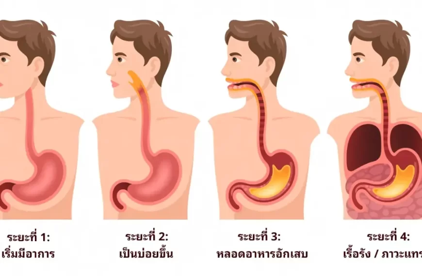 กรดไหลย้อน 4 ระยะ อาการกรดไหลย้อน กรดไหลย้อนเรื้อรัง GERD