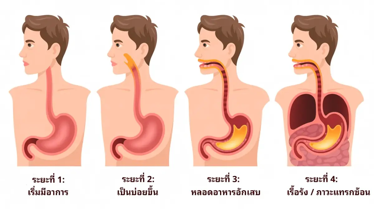 เช็กด่วน! อาการกรดไหลย้อนทุกระยะ
