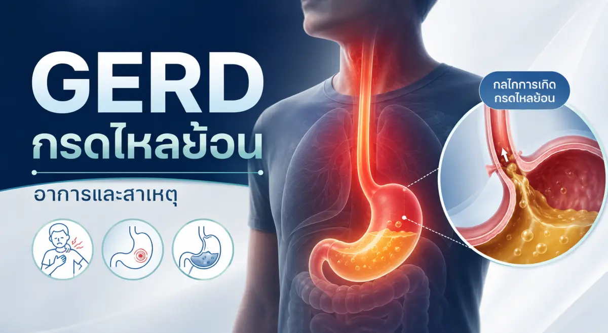 GERD กรดไหลย้อน อาการ สาเหตุ และกลไกการเกิดกรดไหลย้อนในหลอดอาหารและกระเพาะอาหาร