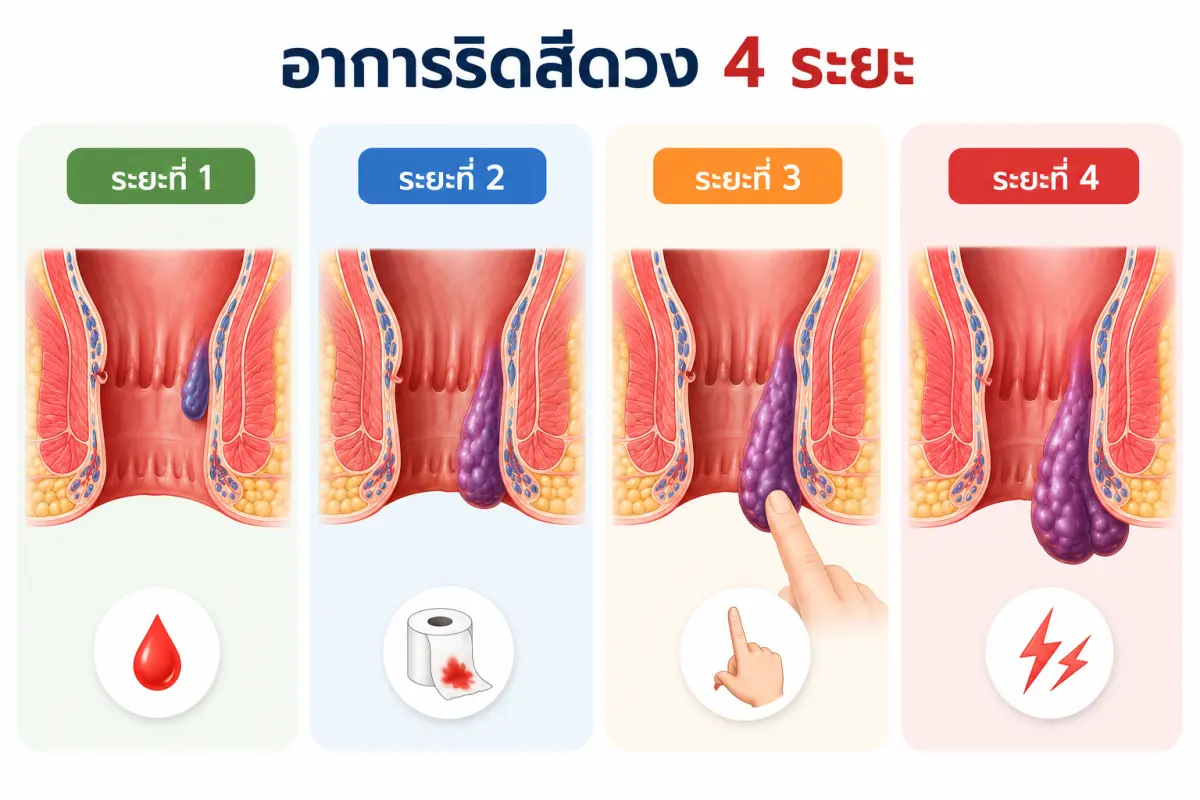 ริดสีดวงทวาร 4 ระยะ คืออะไร อาการและความรุนแรงของริดสีดวงภายในแต่ละระยะพร้อมภาพประกอบ